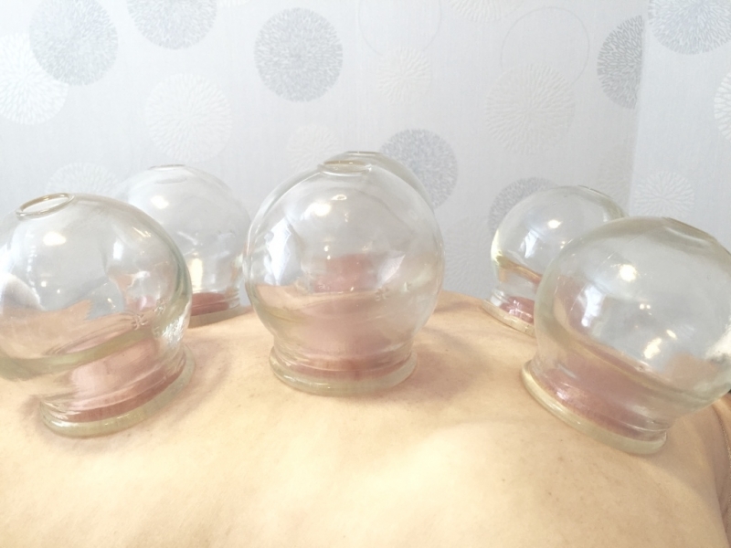 Cupping therapy at BlueWhite Health in Kamloops